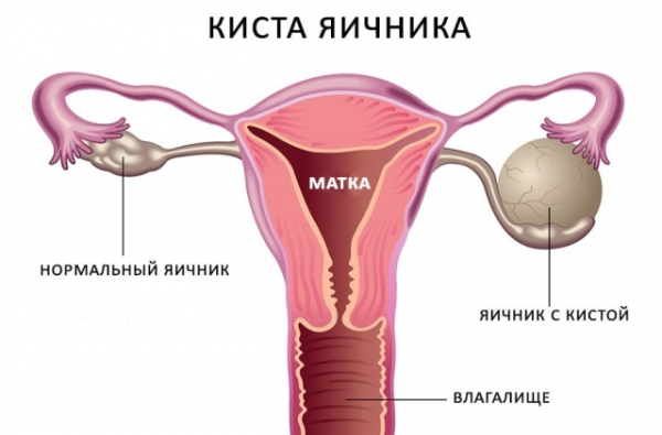 Какие причины мастопатии у женщин